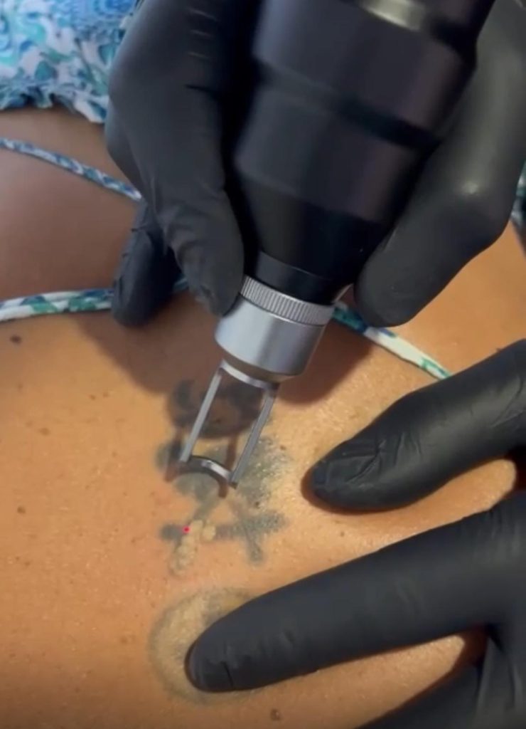 Smart L谩ser Q-Switched Nd:YAG Portable Smart L谩ser Q-Switched Nd:YAG Portable