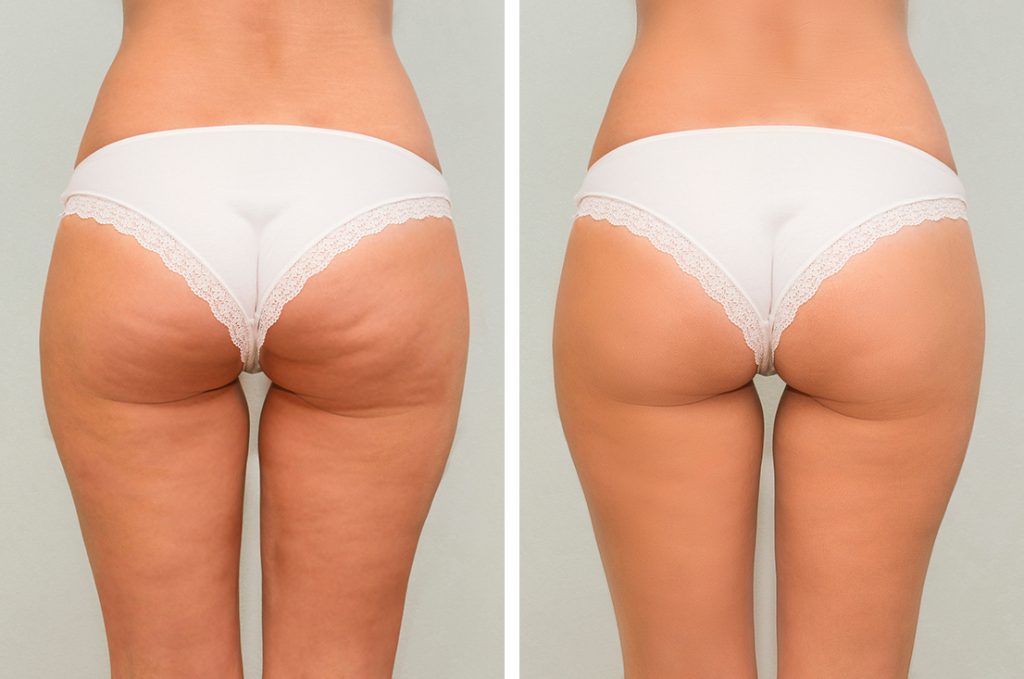SMART PRESOTERAPIA, DRENAJE LINFATICO MECANICO 