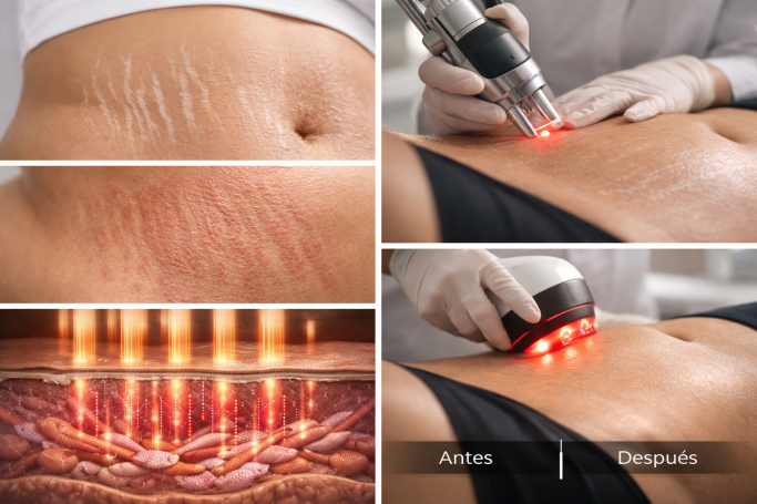 Tratamientos estéticos para estrías, incluyendo láser y tecnología de radiofrecuencia.